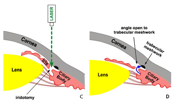 Azione dell'iridotomia laser nel glaucoma ad angola stretto